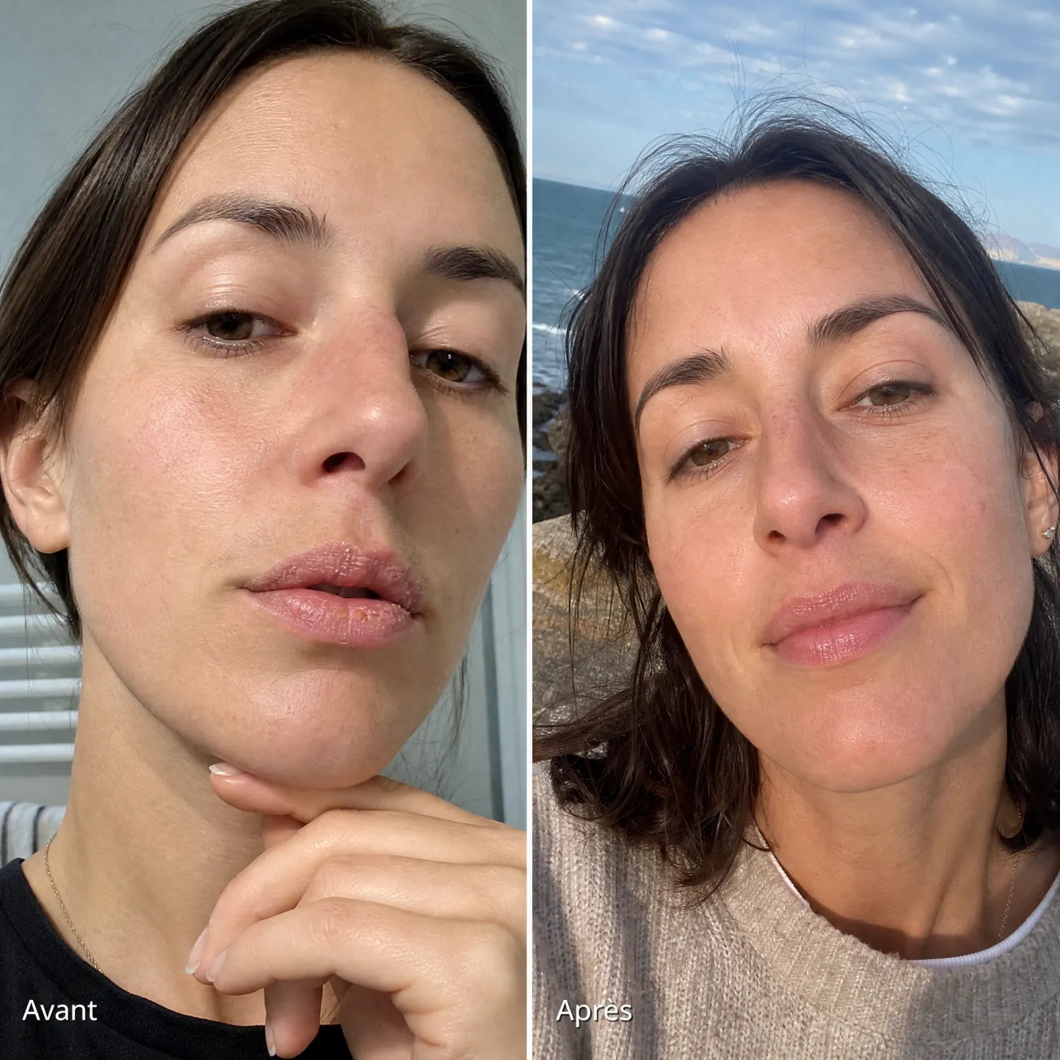 Avant après lèvres gercées traitées au baume Yerba Maté TREW